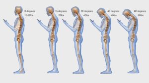 Lee más sobre el artículo Text neck en Madrid: causas, síntomas y tratamiento