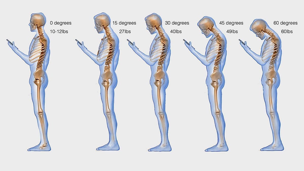 Lee más sobre el artículo Text neck en Madrid: causas, síntomas y tratamiento