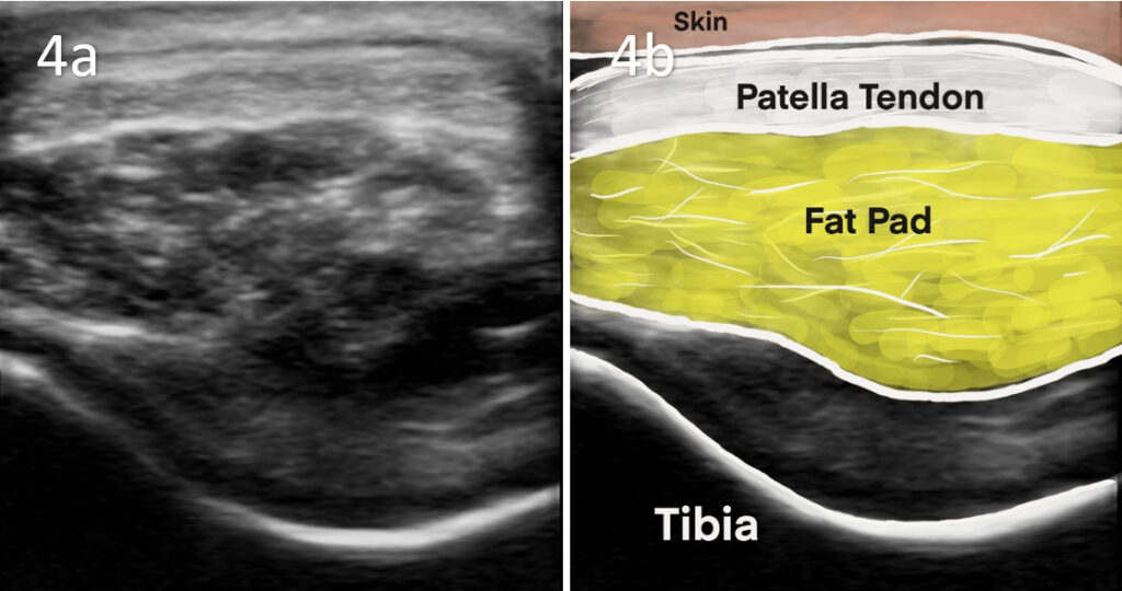 ecografía musculoesquelética aplicada al diagnóstico en fisioterapia