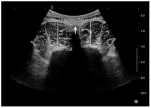 Lee más sobre el artículo Músculo multífido y dolor lumbar: lo que está fallando en tu espalda