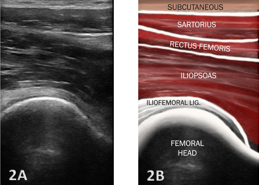ecografia psoas iliaco
